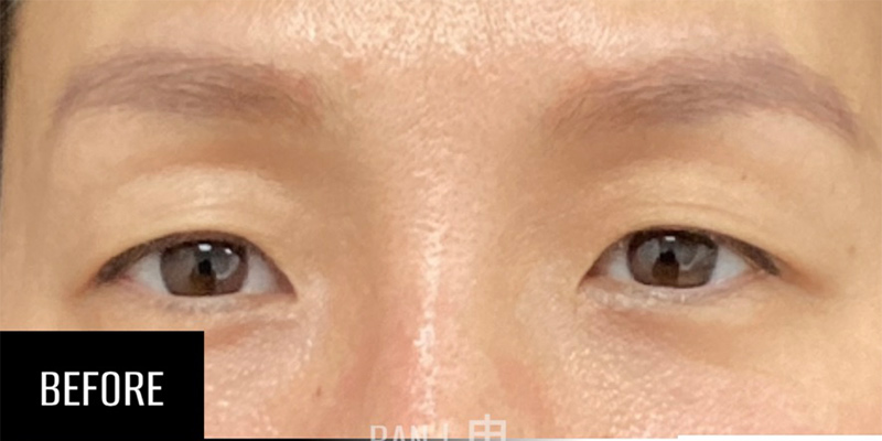 Asian Blepharoplasty Before & After Image