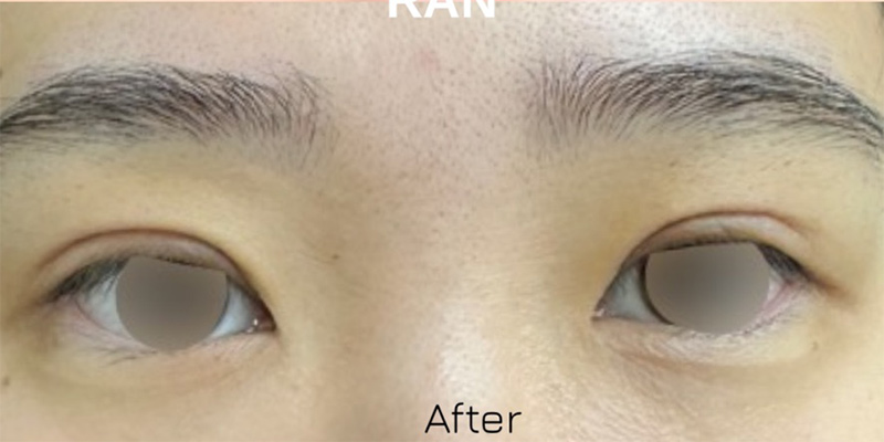 Asian Blepharoplasty Before & After Image