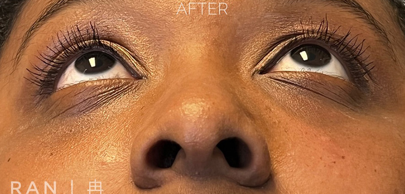 Dermal Filler Before & After Image